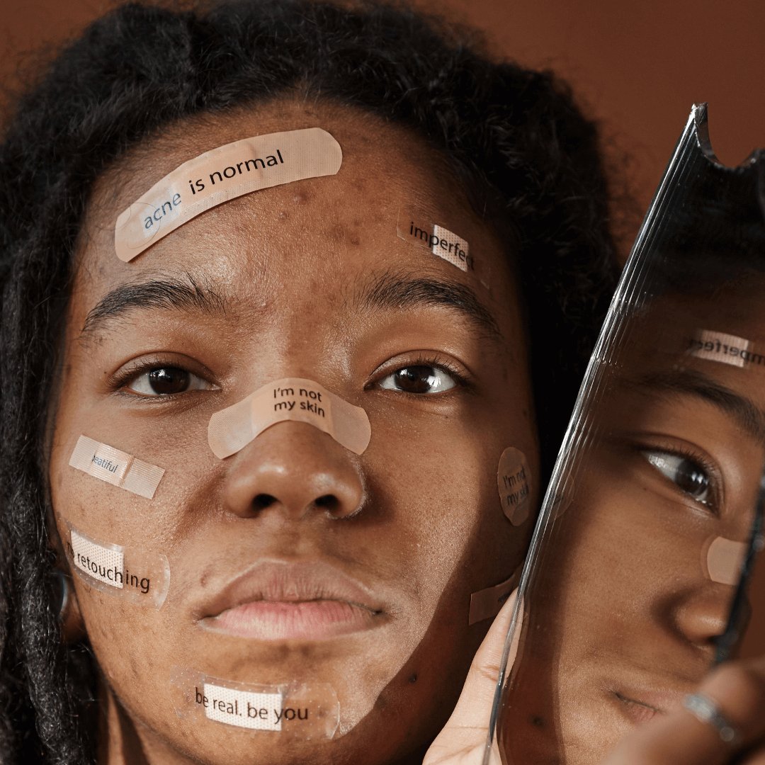 Hablemos de... Acné: tipos y lesiones - Sokobox