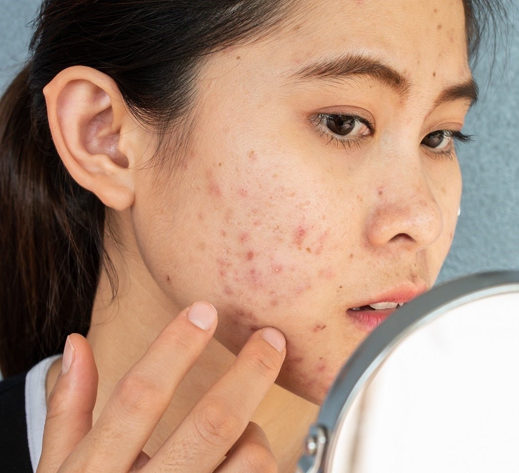 Conoce los tipos de lesiones del acné - Sokobox