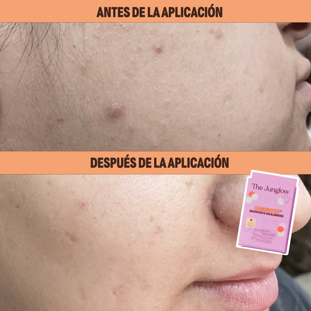 Micropoints for Blemishes