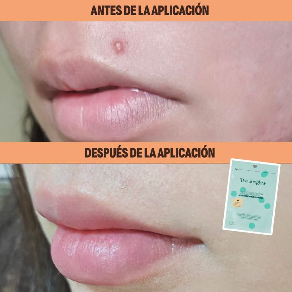 Parche Hidrocoloide | Hydrocolloid for Blemishes