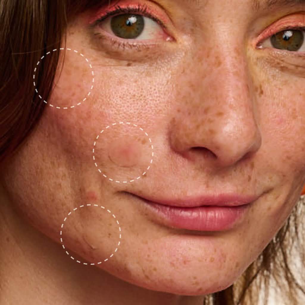 Parche Hidrocoloide | Hydrocolloid for Blemishes