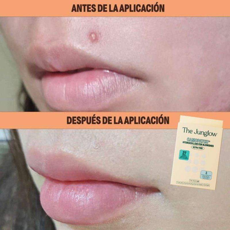 Parche Hidrocoloide | Hydrocolloid for Blemishes - Ultra Thin - Sokobox