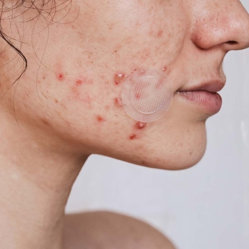 Micropoints for Blemishes - Sokobox
