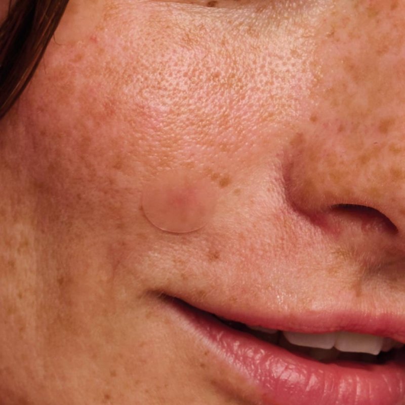 Parche Hidrocoloide | Hydrocolloid for Blemishes - Ultra Thin - Sokobox